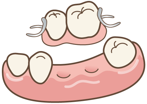 複数本の欠損に対する部分入れ歯での補綴