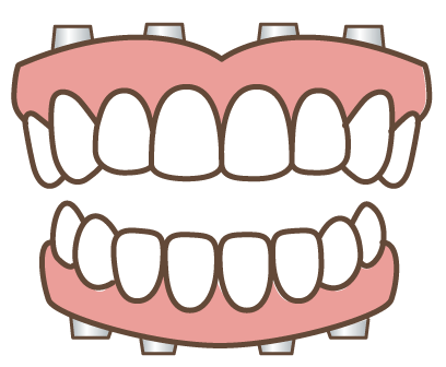 全歯欠損に対するオールオン４